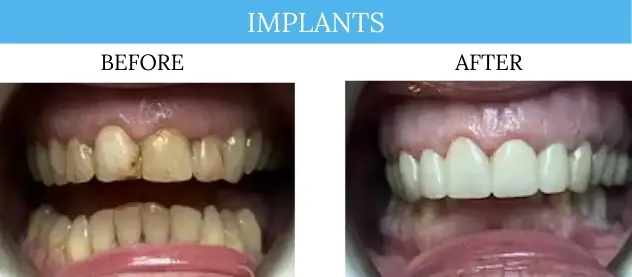Before and after dental implants