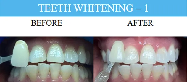 Before and after dental implants