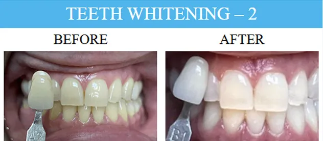 Before and after dental implants