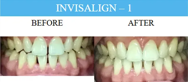Before and after dental implants