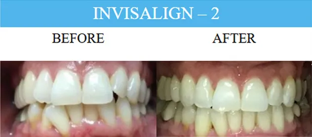 Before and after dental implants