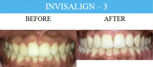 Before and after dental implants