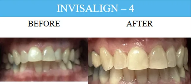 Before and after dental implants