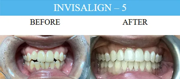 Before and after dental implants