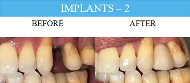 Before and after dental implants