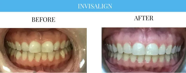 Before and after a Invisalign procedure